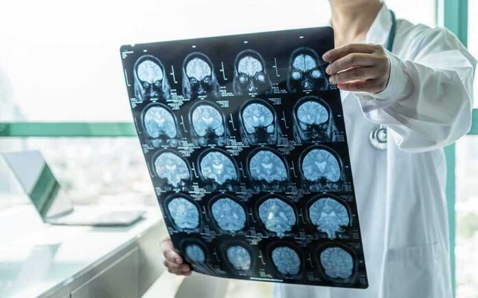 shutterstock_1537198925 Doctor holding brain MRI scan film